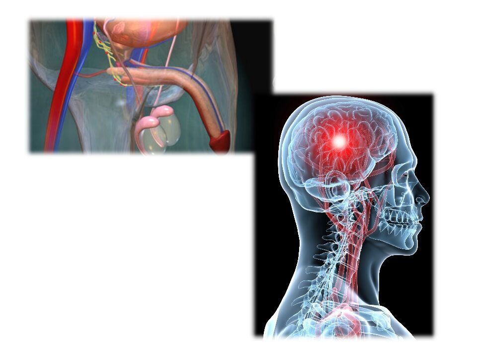 эректильная дисфункция (импотенция) и инсульт головного мозга взаимосвязаны